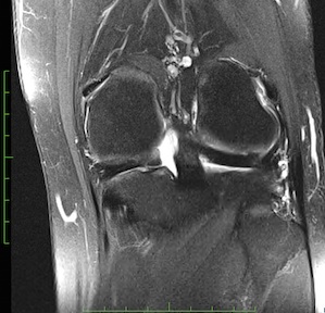 Figure 4 for case Meniscal ossicle